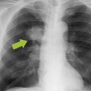 Radiografía pulmonar con sospecha de tumor para visualizar el índice de carcinogenicidad. | © CRB Analyse Service GmbH
